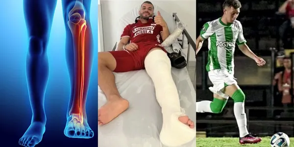 Iago Falque del América de Cali sufrió una fractura en una inesperada jugada con Andrés Salazar de Atlético Nacional.